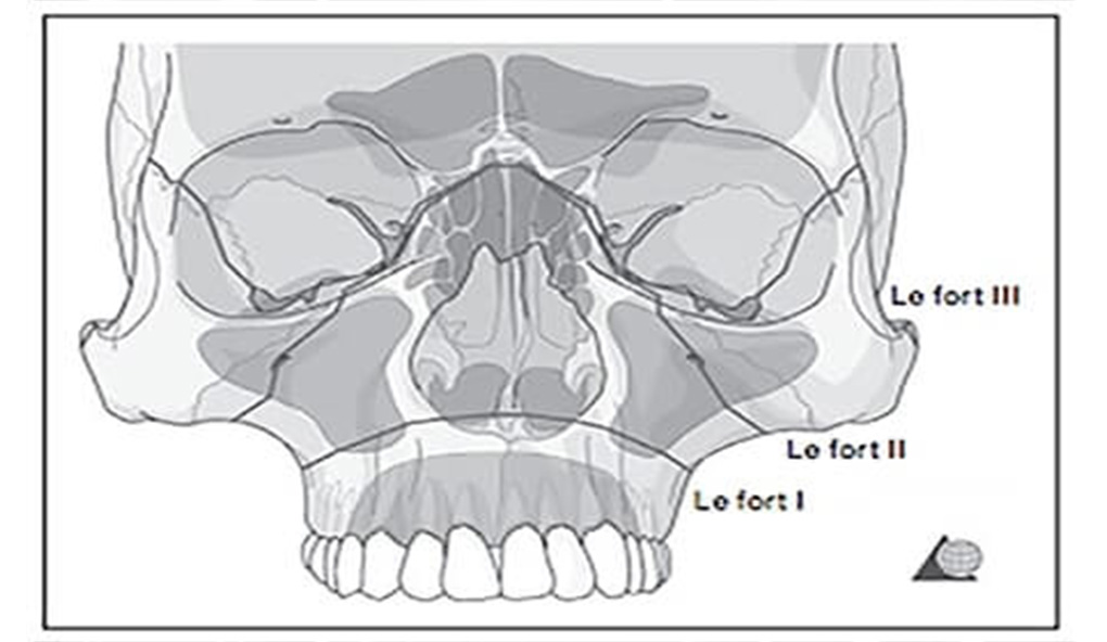 mid-face-fracture