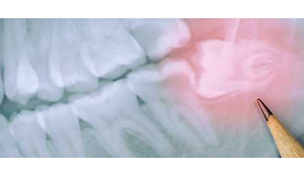wisdom-tooth