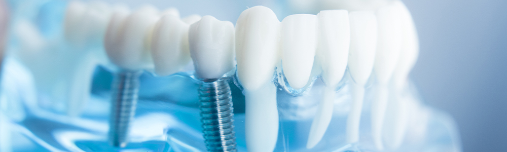 Can you eat with dental implants?