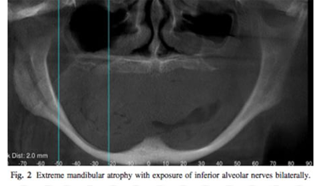 atrophic-edentulous-jaw