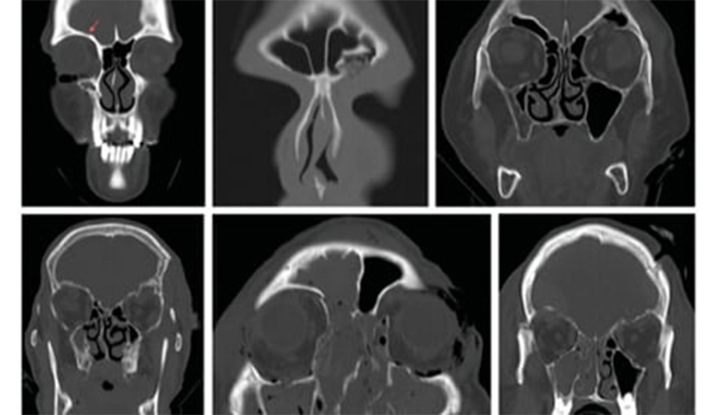 orbital-roof-fractures