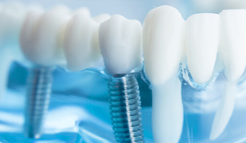 dental-implants