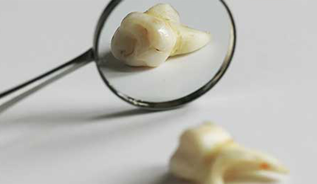 tooth-loss